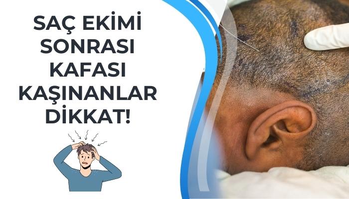 Saç Ekimi Sonrası Kafa Kaşıntısı