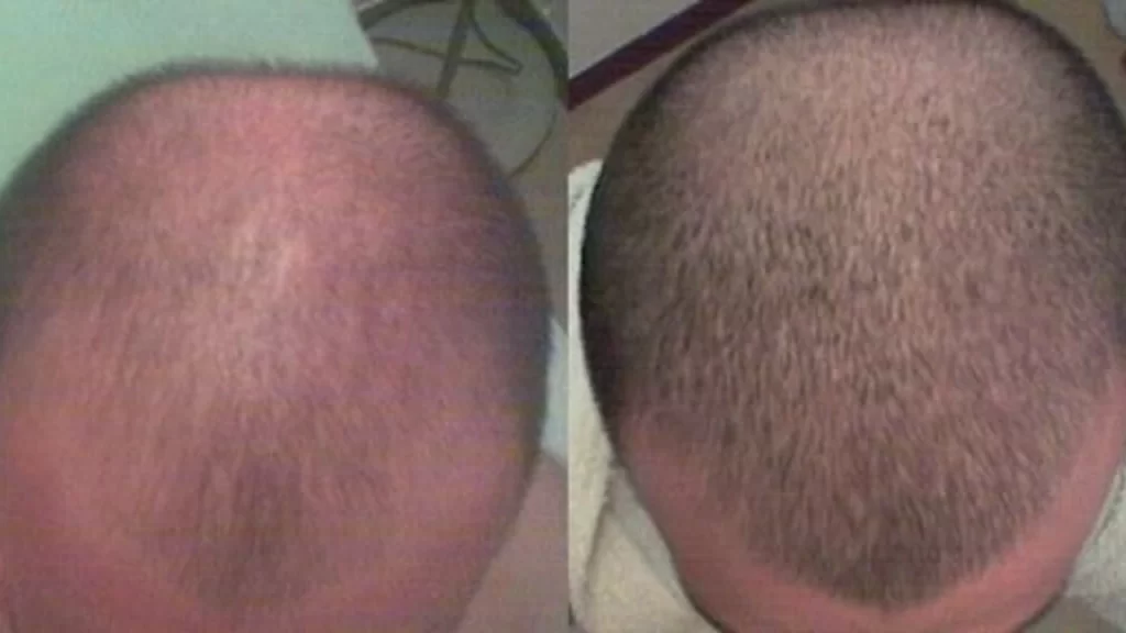 Minoxidil Sonuçları